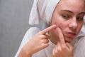 Acne. A teenage girl squeezing out a pimples on her face in front of a mirror. Problematic skin in adolescence. skin care Royalty Free Stock Photo