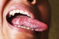 Acne on the tongue