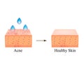 Acne treatment with acid peeling. Black spots of blackheads on the skin. Acne black. Pore cleansing. The anatomical