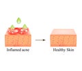 Acne treatment with acid peeling. Inflamed acne skin. Pimple inflamed. Pore cleansing. The anatomical structure of the