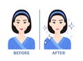 Acne treatment. Before and after. Asia Woman with problem skin, Pimles. As a result, a Clean Face. Flat color cartoon style.