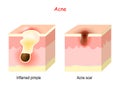 Acne treatment. Inflamed pimple and Acne scar