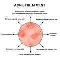 Acne treatment. Pustules, papules, comedones, blackheads, acne on the skin. Infographics. Vector illustration on