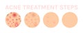 Acne Treatment Steps. Whitening of Human Skin. Facial Pimples on Problem skin. Close Up of Clean Healthy skin. Color Realistic