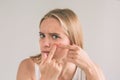 Acne treatment. Acne woman. Young woman squeezing her pimple, removing pimple from her face. Woman skin care concept