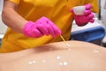 Acne treatment with zinc ointment. The back of a woman. The hands of a cosmetologist smear skin rashes with ointment.