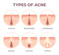 Acne types anatomy. Pimple diseases sectional view blackhead, cystic and whitehead. Structure of skin and pore infection