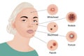 Acne types Cosmetology