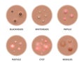 Acne types on dark skin, face pimples and comedones, vector blackheads and pore cysts. Skin acne types, cosmetology and skincare