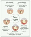 Acne types. Medical illustration. Infographic about skin and dermatology