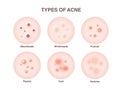 Acne types set