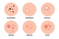 Acne types set. Skin disease, dermatology, cosmetology concept.