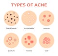 Acne types. Skin infection problem, pimples grade and type cyst, whitehead, blackheads, nodule and cystic. Dermis pore disease