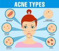 Acne types, skin pimples blackheads and face comedones. Infographics of acne. Girl with types of acne. Skin acne pimples