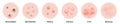 Acne types, skin pimples blackheads and face comedones. Vector icons of skin acne pimples, cosmetology skincare problems Royalty Free Stock Photo