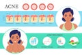 Acne flat vector face skin treatment infographic