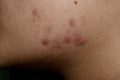 Acne vulgaris, black spots and scars on face of Asian young woman Royalty Free Stock Photo