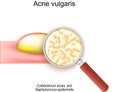 Acne vulgaris. Cross-section of a human skin with pimple. Magnification glass and bacteria that cause of acne