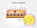 Acne Vulgaris. Vector design.