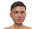 Acne vulgaris in a teenager boy