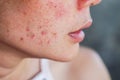 Acne on woman`s face with rash skin ,scar and spot that allergic to cosmetics