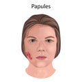 Acne. Papules. Young woman face with skin inflammation.