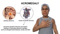 Acromegaly, 3D illustration