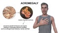 Acromegaly, 3D illustration