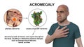 Acromegaly, 3D illustration