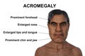 Acromegaly in a man, 3D illustration