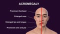 Acromegaly in a man, 3D illustration