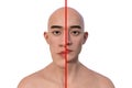 Acromegaly in a man, and the same healthy man, 3D illustration