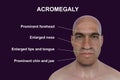 Acromegaly in a man, and the same healthy man, 3D illustration