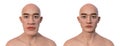 Acromegaly in a man, and the same healthy man, 3D illustration Royalty Free Stock Photo