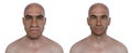 Acromegaly in a man, and the same healthy man, 3D illustration