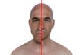 Acromegaly in a man, and the same healthy man, 3D illustration