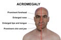 Acromegaly in a man, and the same healthy man, 3D illustration