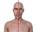 Acromegaly in a man, and the same healthy person, 3D illustration