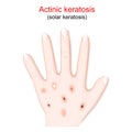 Actinic keratosis. solar keratosis