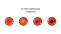 Actinic keratosis. malignization