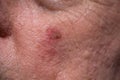 Actinic keratosis or sunspots on sun-damaged skin