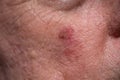 Actinic keratosis or sunspots on sun-damaged skin