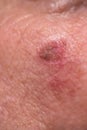 Actinic keratosis or sunspots on sun-damaged skin