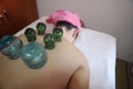 Detail of Woman with Acupuncture Cupping Treatment Royalty Free Stock Photo