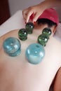 Detail of Woman with Acupuncture Cupping Treatment Royalty Free Stock Photo