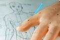 Acupuncture needle on hand model Royalty Free Stock Photo