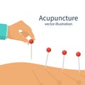 Acupuncture treatment closeup