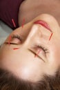 Acupuncture treatment to face