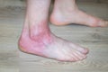 acute allergy, swollen and red foot, allergic reaction, itchy skin, health concept