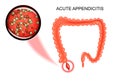 Acute appendicitis. bacteria Royalty Free Stock Photo